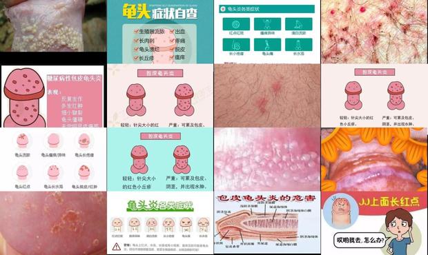 汕頭龜頭炎癥狀對照圖片