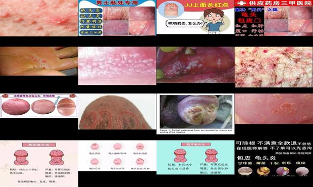 汕頭念珠菌性龜頭炎癥圖片