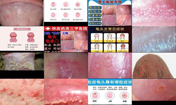 汕頭包皮炎龜頭炎癥狀