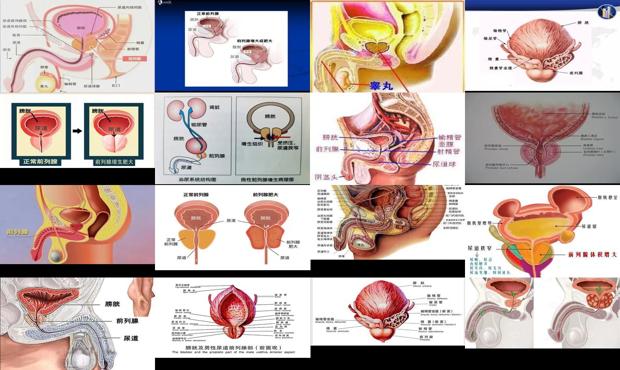 汕頭前列腺