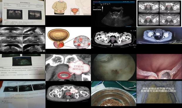 汕頭前列腺鈣化