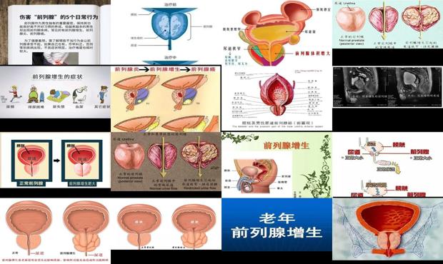 汕頭前列腺增生