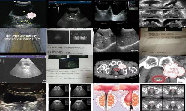 汕頭前列腺鈣化灶