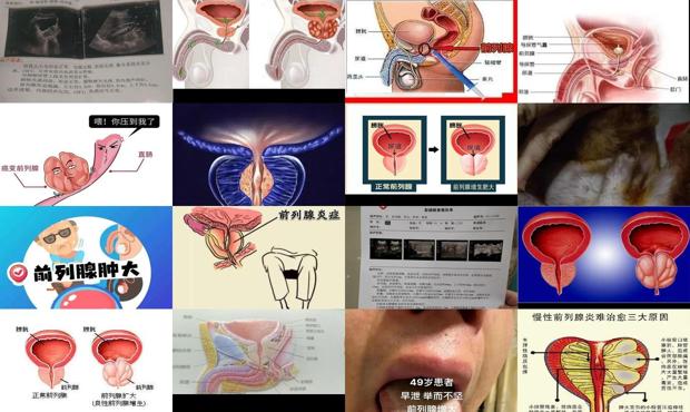 汕頭前列腺腫大