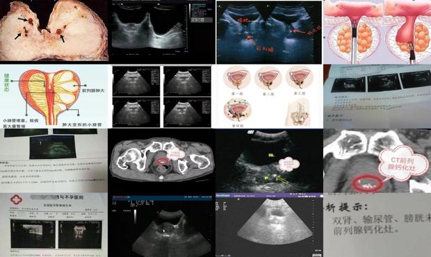 汕頭前列腺鈣化灶什么意思