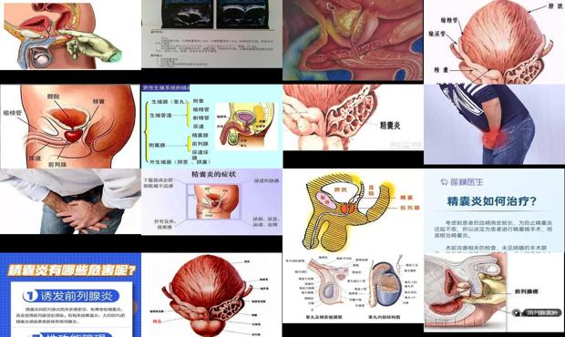 汕頭前列腺精囊炎