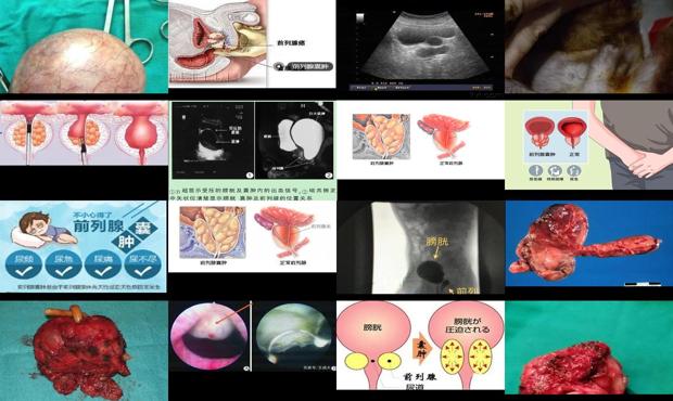 汕頭前列腺*是怎么回事