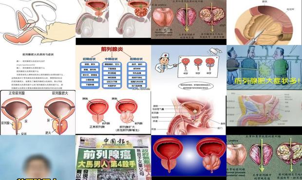 汕頭前列腺肥大的