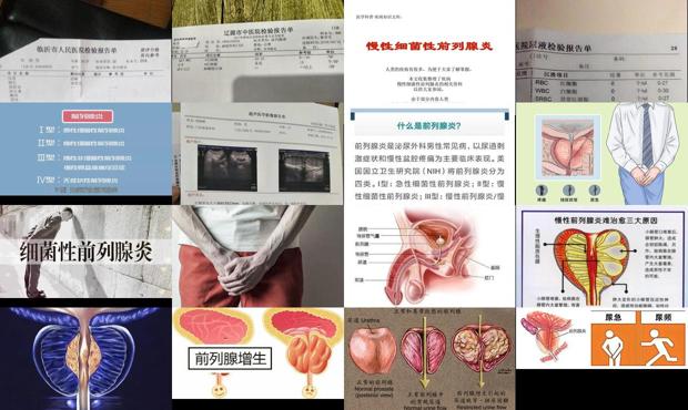 汕頭慢性非細(xì)菌性前列腺炎