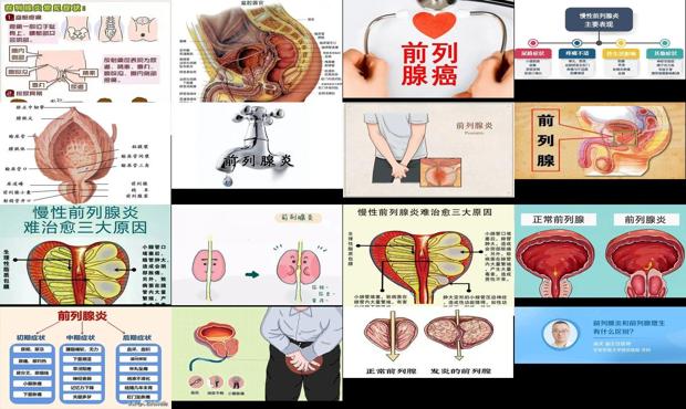 汕頭前列腺炎癥狀圖