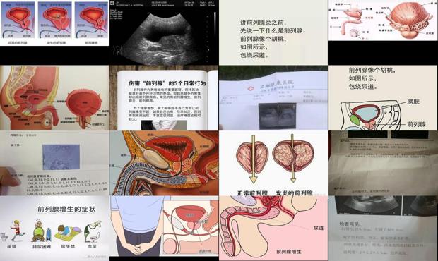 汕頭前列腺稍大是什么意思