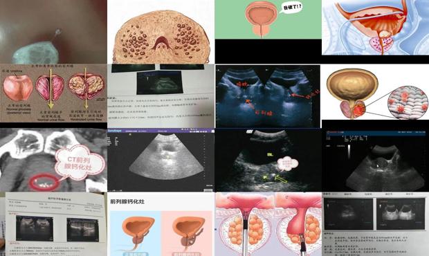 汕頭前列腺鈣化灶是啥意思