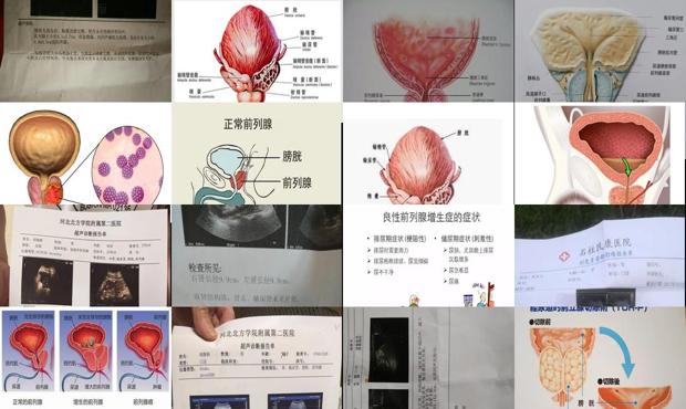 汕頭前列腺稍大